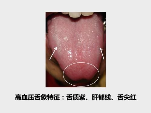 mmhg|50多岁大姐近来老是头晕，一量血压高压180，原来舌象早已预警