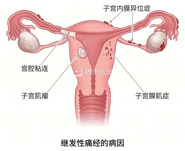 经期|以前不痛经的人，突然开始痛经，要注意这个病