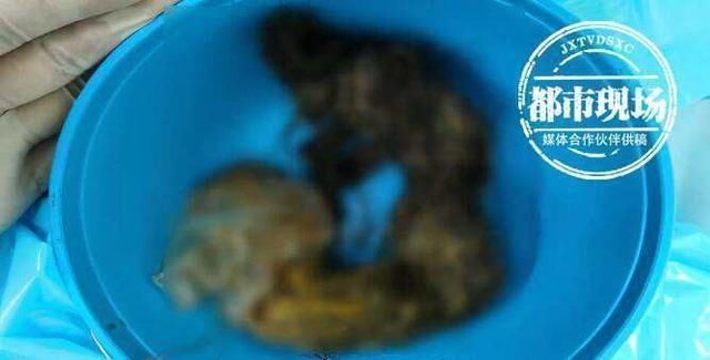 深圳市人民医院|头皮发麻14岁女孩胃里塞满这些,这个可怕的习惯她保持了十年