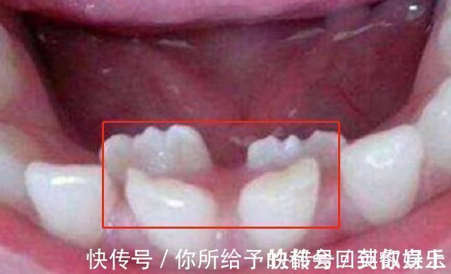 恒牙|6岁男娃长“双层牙”,老人的“坏习惯”害了娃,你家有这习惯吗