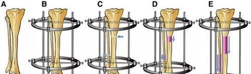 学生|高三学生因身高矮小自卑,花16万断骨增高7.2厘米,如今怎样?