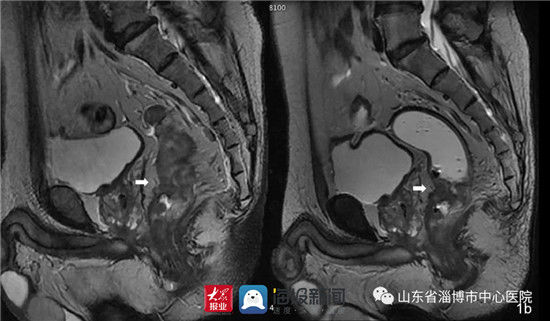 病变|淄博市中心医院放射科巧用耦合剂灌肠行高分辨率MRI精准诊断