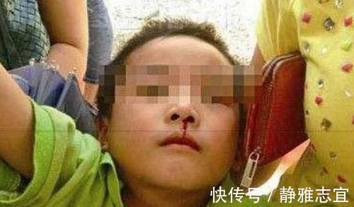 鼻血|3岁男孩摔倒流鼻血,宝妈错误的处理后,医生也“无力回天”