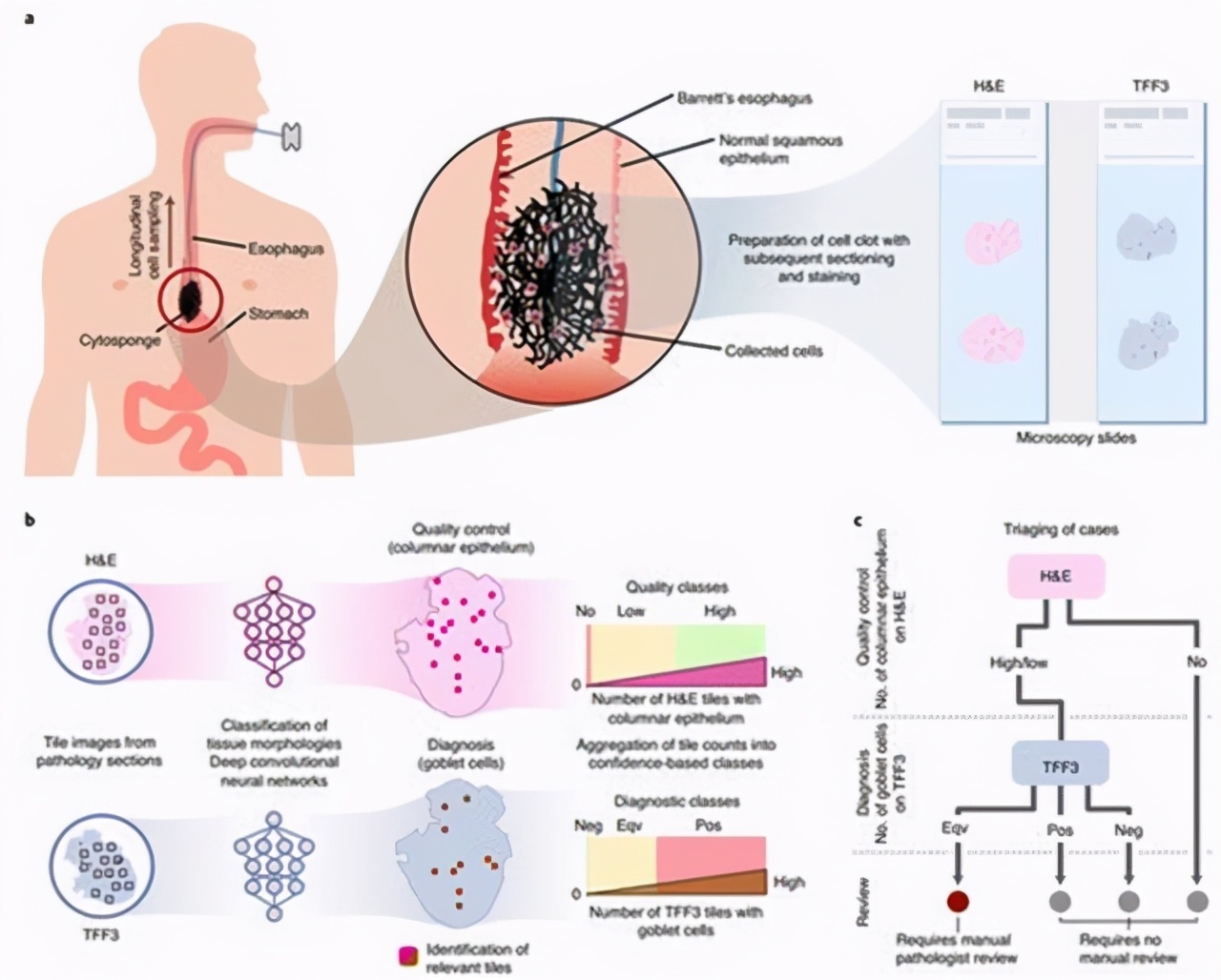 慢性咽喉炎|慢性咽炎就诊，却查出了食管癌，二者该如何分辨医生告诉你