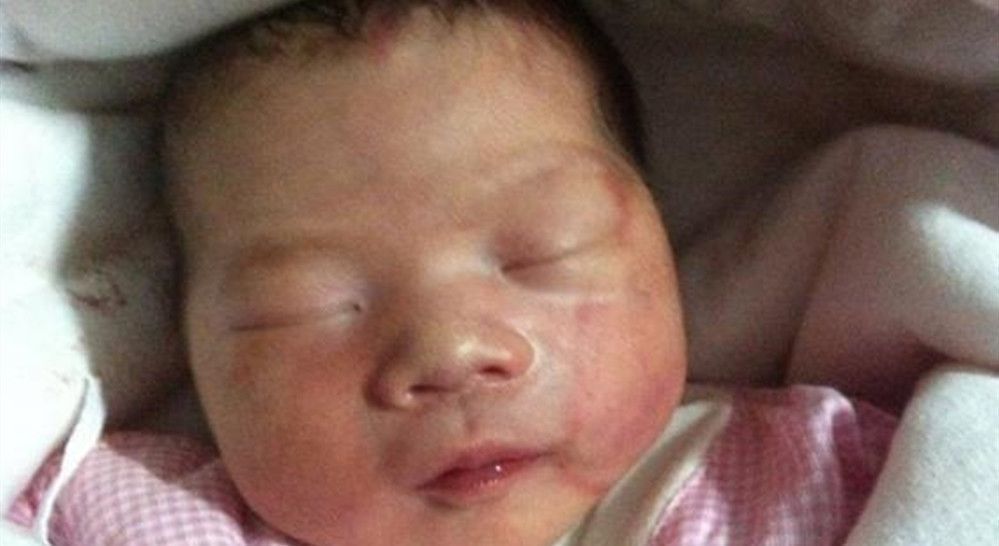 钳印|孩子1岁脸上“产钳印”不消,找医生被反驳,宝妈无言以对