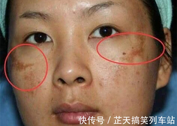 发黄|肝是“哑巴”,如何判断肝好不好?若有这5体征,抽空去趟肿瘤科