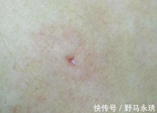 棉花丝|有痔疮的人,后腰常有“红色小点”,里面藏着“棉花丝”