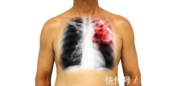 栓塞|这5类人,若出现胸痛的表现,及时检查,当心肺栓塞找上门