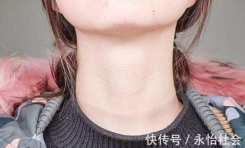 症状|淋巴结肿大不是淋巴癌的唯一症状,得了淋巴癌,还会有哪些异常