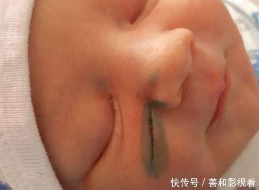 女子|19岁女子剖腹产，医生竟一刀划进女婴小脸，伤口深见肉她当场吓哭