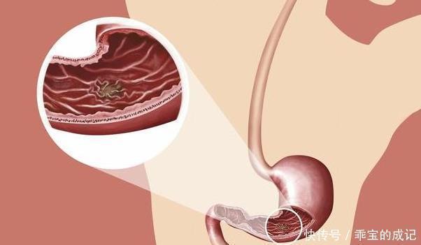 胃部|胃癌早期不痒不疼,饭后若出现4个“异常”,多半需要就医了