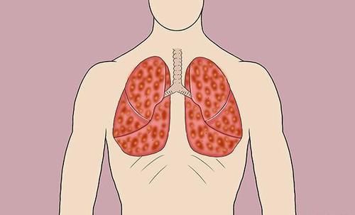  咳嗽|肺内有没有癌，咳嗽先知晓？咳嗽时有2个异常，肺癌或已登门