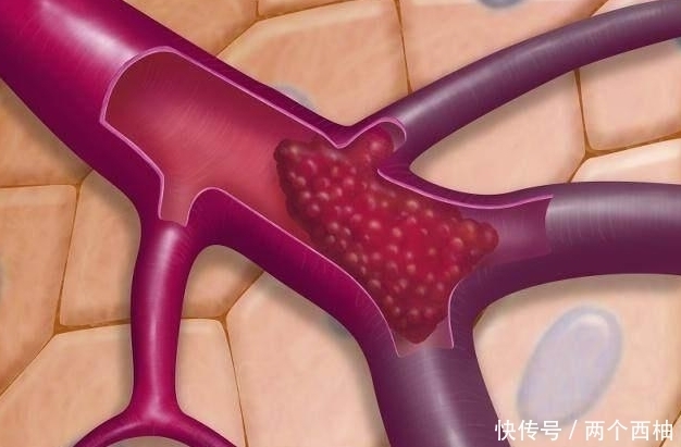  中风的几率|减少脑血管垃圾，预防脑中风，多喝3水，它惧怕的3事少做