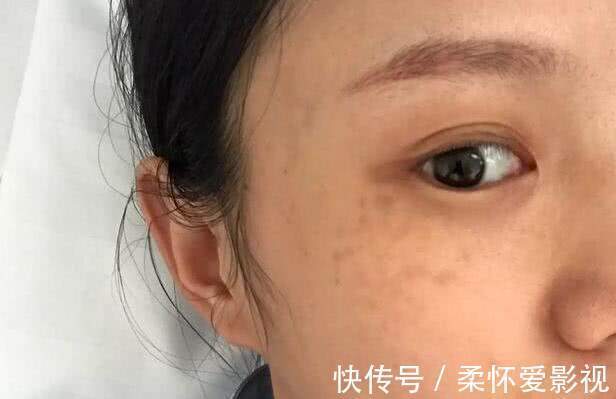 胆固醇|血脂高不高,全写在脸上!脸上出现5个“表现”,请及时调理