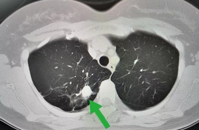 诱发|诱发肺结节形成的原因有哪些?