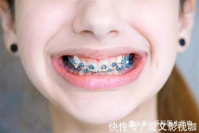 儿童|儿童牙齿矫正的黄金时期，家长们不要错过了！