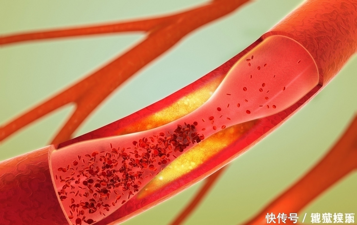 中老年人|保护心脑血管,这些食物是天然的“阿司匹林”,每天一点远离血栓