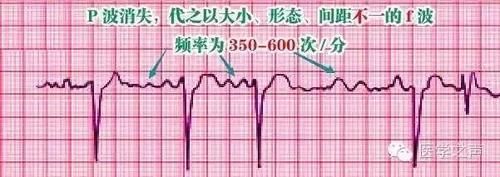 护士这样学心电图，不用死记硬背