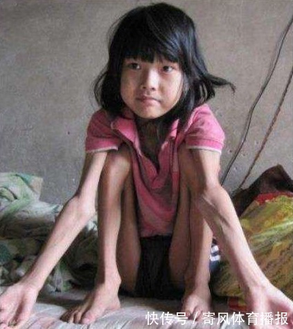 皮包骨|6岁女孩莫名瘦到皮包骨,妈妈一句“没带项链”,惊吓到医生