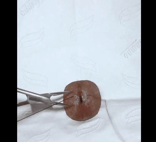 手术|给火龙果割阑尾33岁水果医生爆红吸粉90万网友看到第一个就痛了