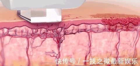 皮肤 光子嫩肤种类那么多,为什么建议使用OPT技术的仪器