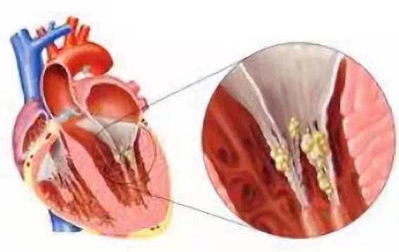 难题|七旬老人反复发热竟是心内膜炎，心外科二尖瓣生物瓣膜置换解难题