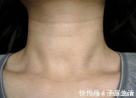 肌肤|无论男女，脖子上出现这种“问题”，别大意！赶紧采取措施
