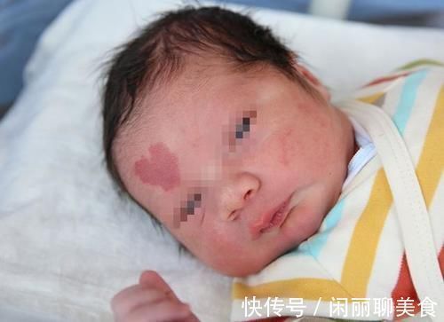 胎记|宝宝出生自带胎记,全家乱了套,医生解释:只因妈妈没管住嘴
