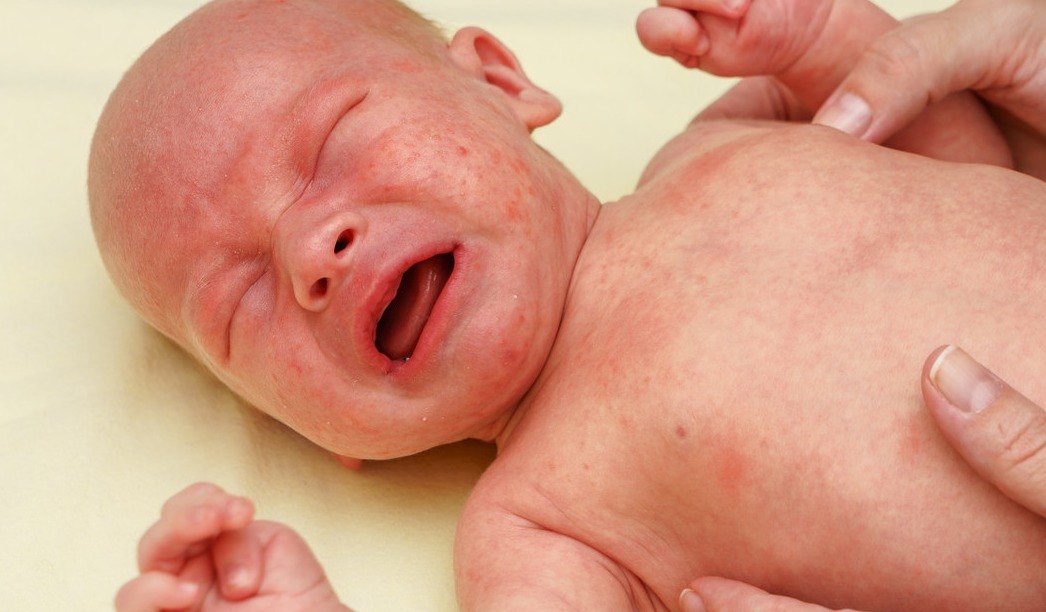 豌豆|新生儿宝贝长了好多湿疹,什么原因,2招教你快速搞定