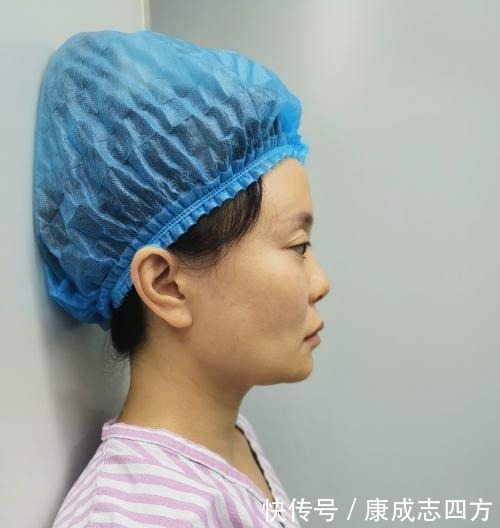 求美者|小拉皮术后1个月,总结几点我的体验感受