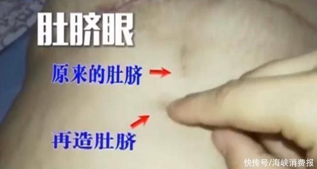 整形医院|女子花4万元做整形，把肚脐眼“整没了”，十分崩溃