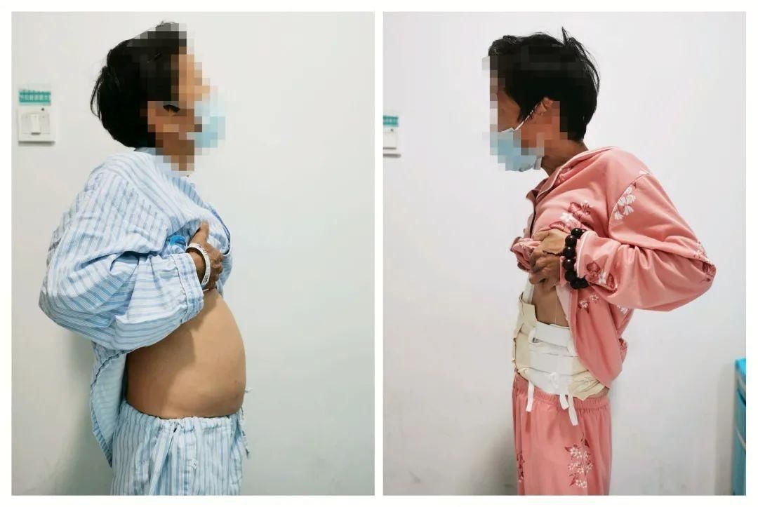 五旬女子“怀胎”10年“生下”西瓜大肿瘤,不换血管摘瘤省了五六万