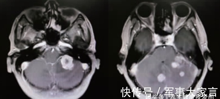 李明|打破肺癌晚期最多存活半年“魔咒”，晚期癌症带瘤生存4年病例