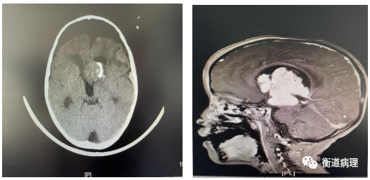 脑肿瘤|病例讨论：儿童脑肿瘤一例