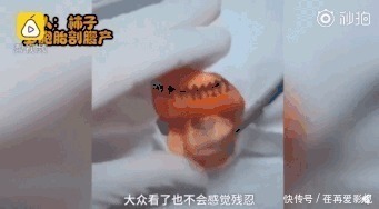 王醫生|32歲醫生竟給水果做手術？一夜吸粉12萬！網友：“我的膝蓋跪爛了”