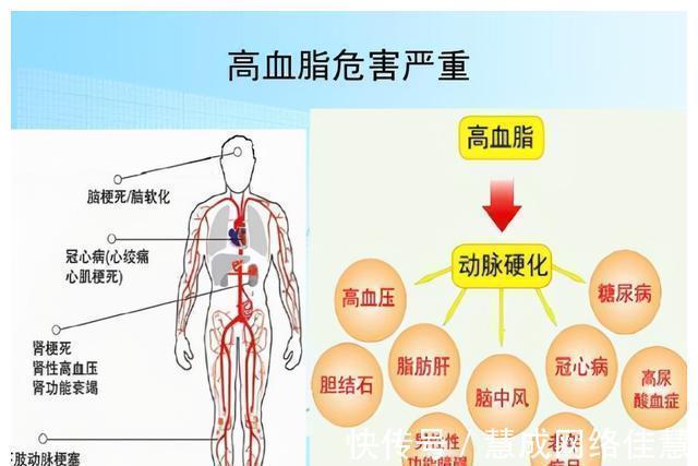 甘油三酯|不吃药，真能降血脂吗？医生确认了：能！但要认准这2种高血脂