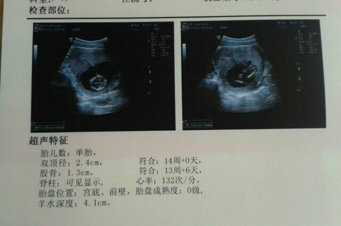 宝宝|怀孕后成功闯关这5次孕检,孕妇可以放宽心了,宝宝会健康到来