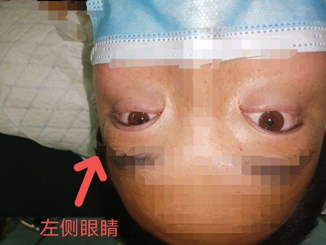 回事|手术中病人突然眼花，原来是这么回事