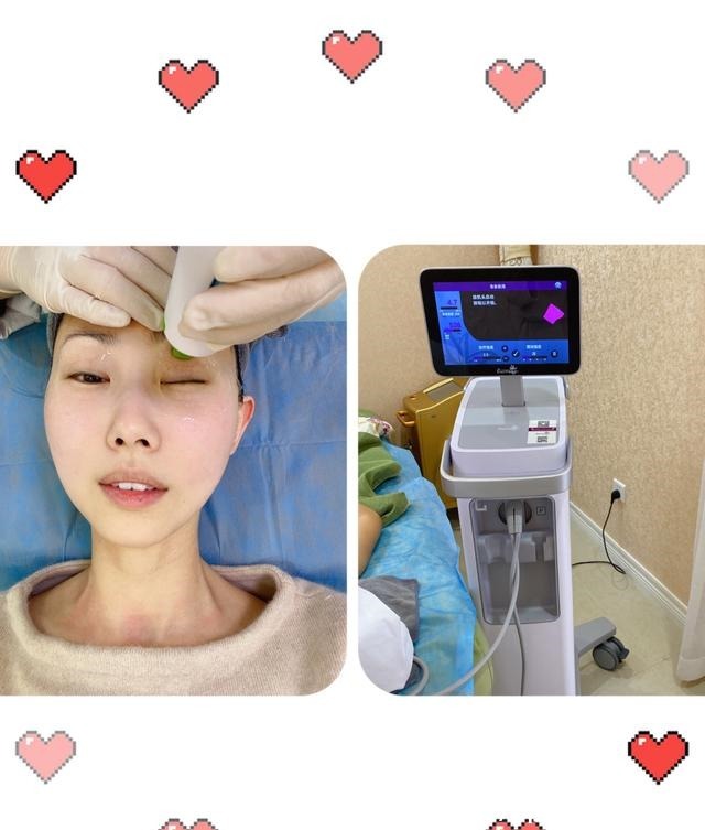 周大 花同样的钱做眼部热玛吉值得吗丨眼部热玛吉初体验!