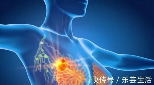 转移癌|发现淋巴结肿大,是肿瘤转移了吗?肿瘤医生教你来判断