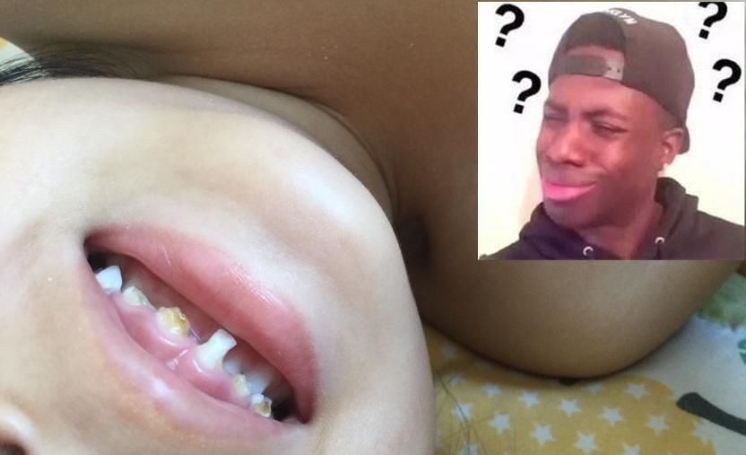 宝宝|4岁孩子一嘴黑牙,妈妈毫不在意认为牙齿能换,牙医叹气无知