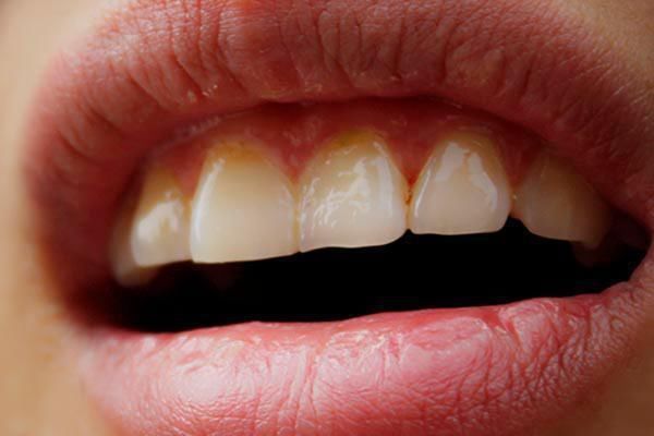 牙缝抠出“黄泥”,又臭又软?这些方法可帮助清除,清新口气