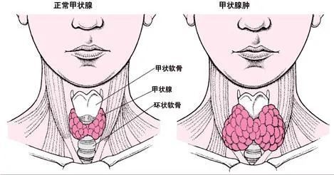 甲状腺癌|【青岛市胶州中心医院】教您读懂化验单—甲状腺功能检查