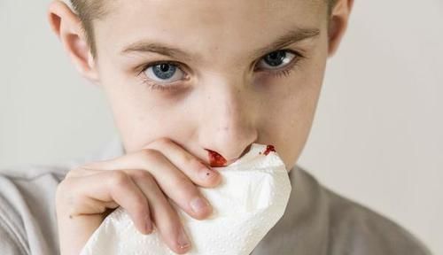 流鼻血后，要仰头、塞纸？别再错了，正确的处理方法记住这3点