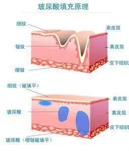 真皮层|济南海峡整形科普：玻尿酸哪些坑千万不能踩？