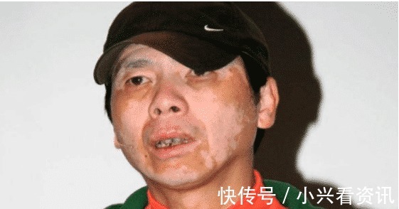 导演冯小刚白癜风恶化,身价不菲为何不治