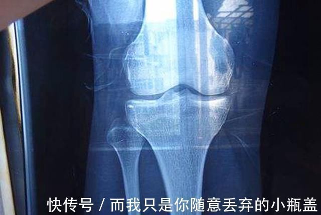 性早熟|8岁女孩身高停在1米2,检查结果为骨垢线闭合,只因一款保健品