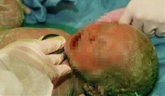 小花|90后孕妈怀孕35周,被迫剖腹产生下“绿娃娃”,医生怒斥太无知