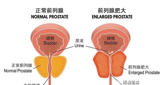 像剥橘子一样去除前列腺增生