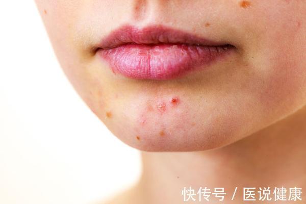 肝火|身体出现5个问题，或是肝火旺的信号，掌握4个方法，及时降肝火